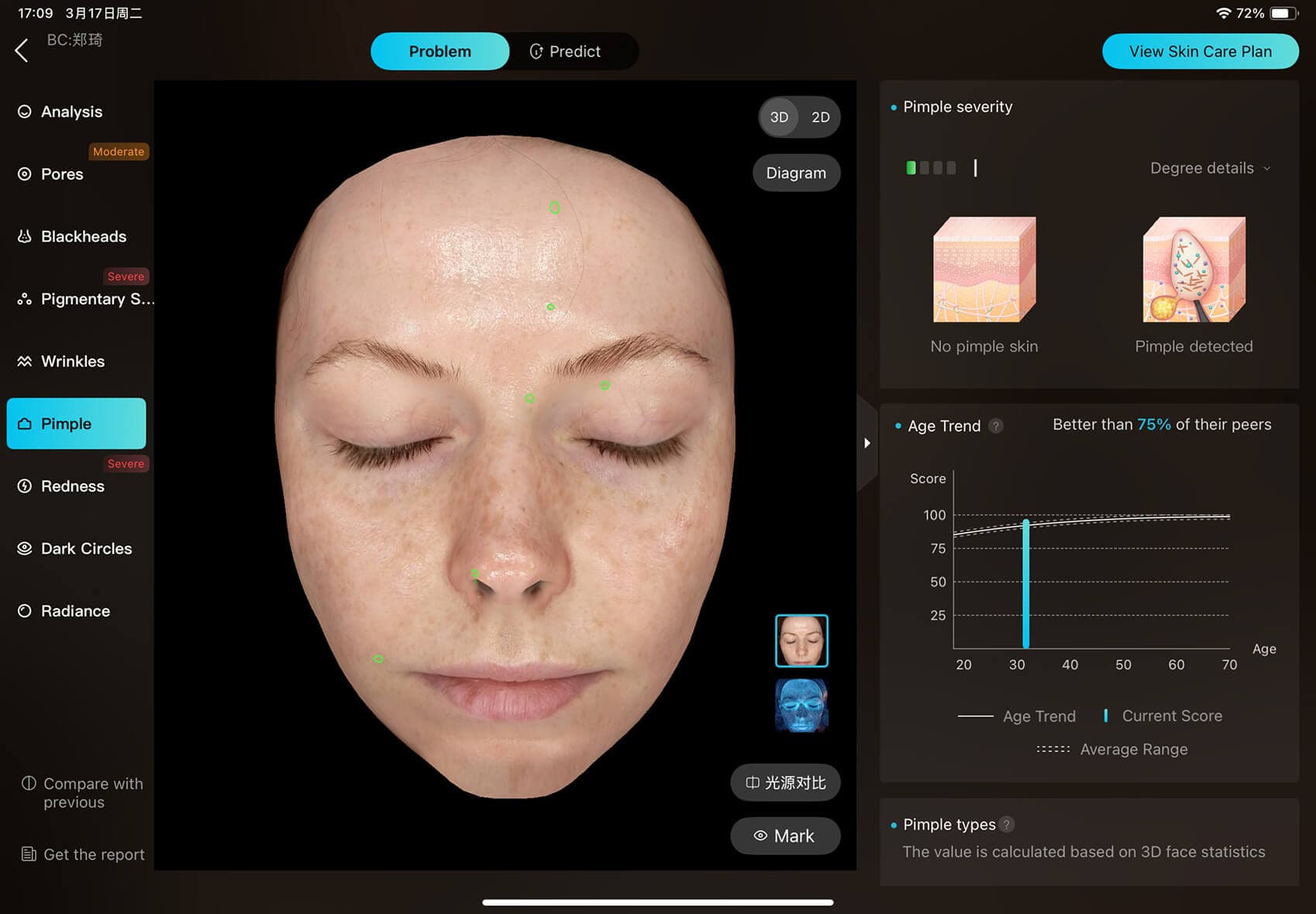 Acne Scar Analysis visualization