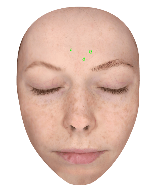 pimple Scars